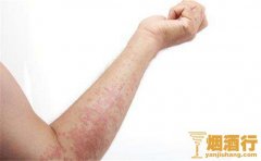 吃海鲜喝酒过敏怎么办，喝酒吃海鲜过敏的症状